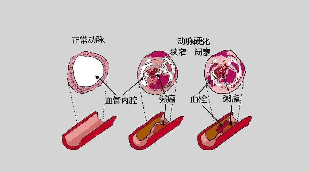 動脈硬化應(yīng)該注意哪些飲食戒律？