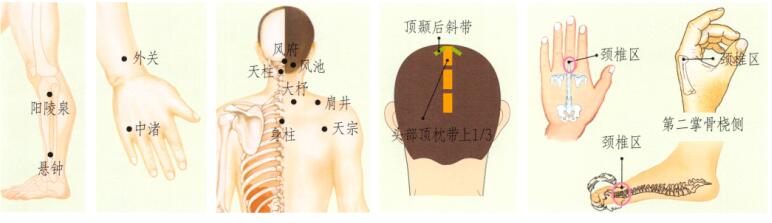 頸椎病刮痧