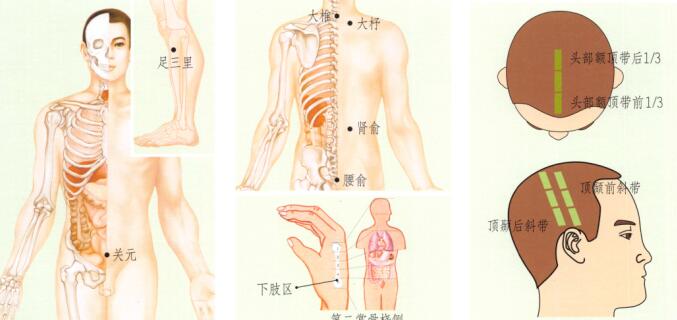 風濕性關節(jié)炎刮痧